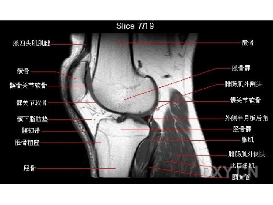 膝部MRI解剖基础医学课件_第5页