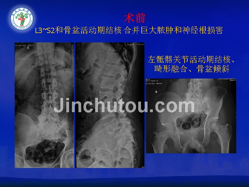 治疗活动期连续性多椎体脊柱结核合并多神经根损害和巨大脓肿的miniopen术式简介_第5页