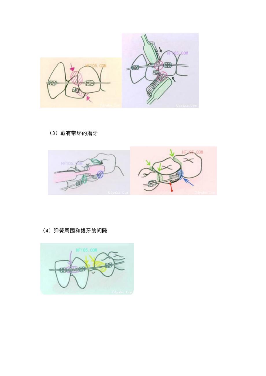 牙齿矫正的刷牙方法_第2页