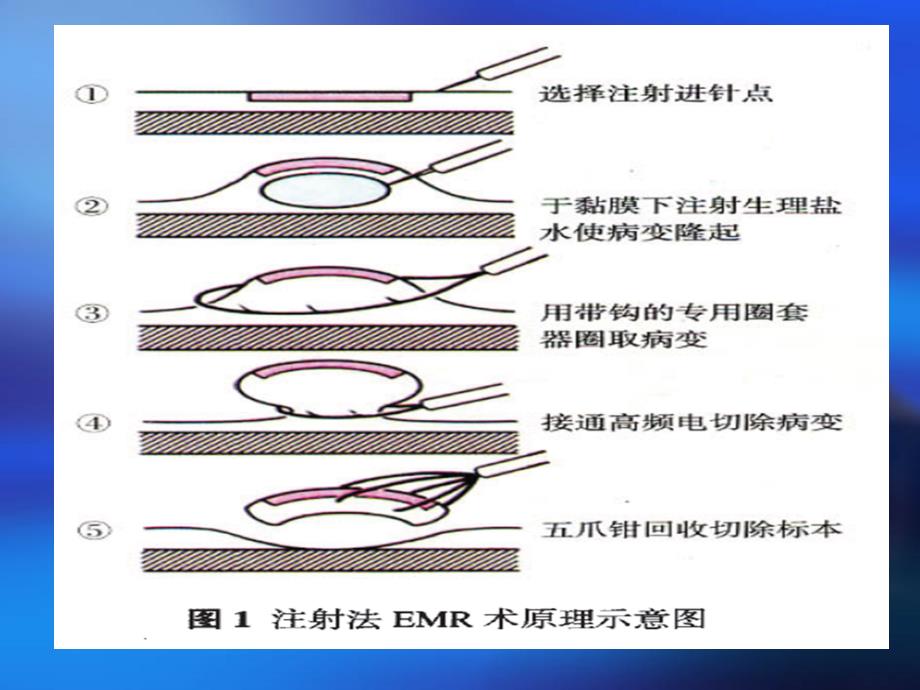 消化系统解剖EMR与ESD内镜下粘膜下剥离术及内镜下粘膜切除术_第4页