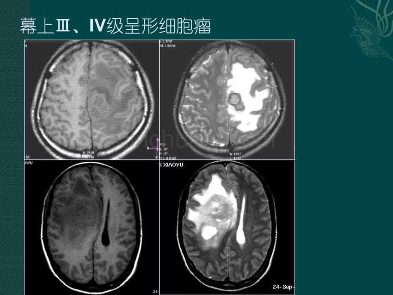 磁共振成像读片题_第2页