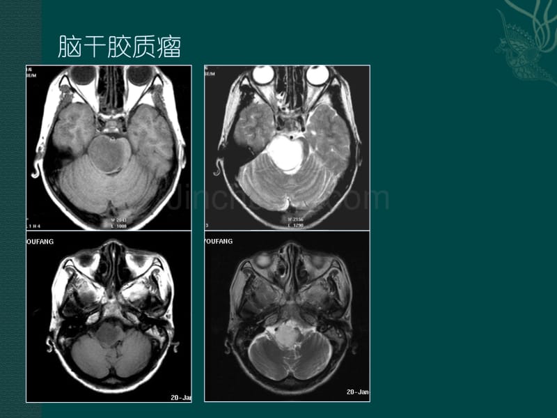 磁共振成像读片题_第4页