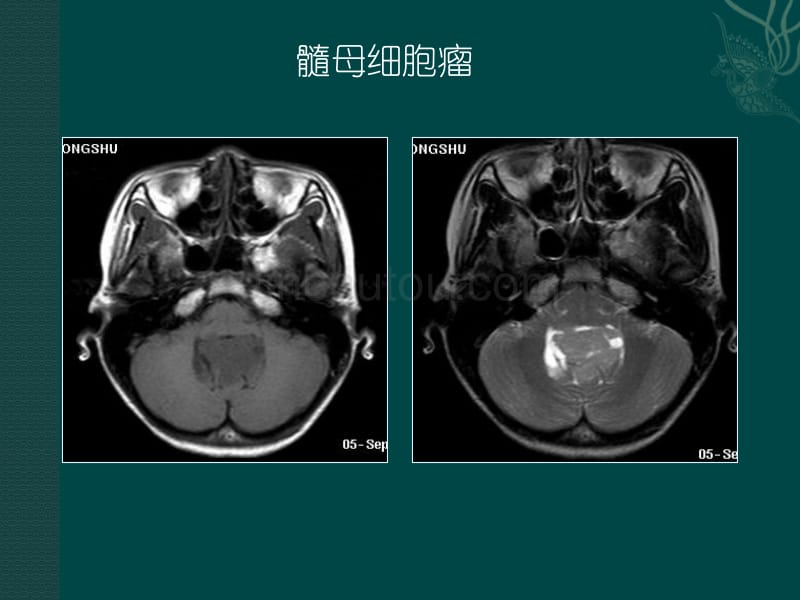 磁共振成像读片题_第5页