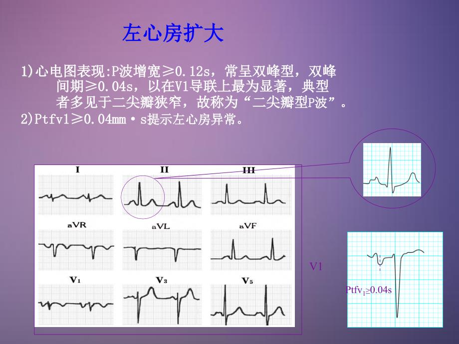 简单学心电图_第3页