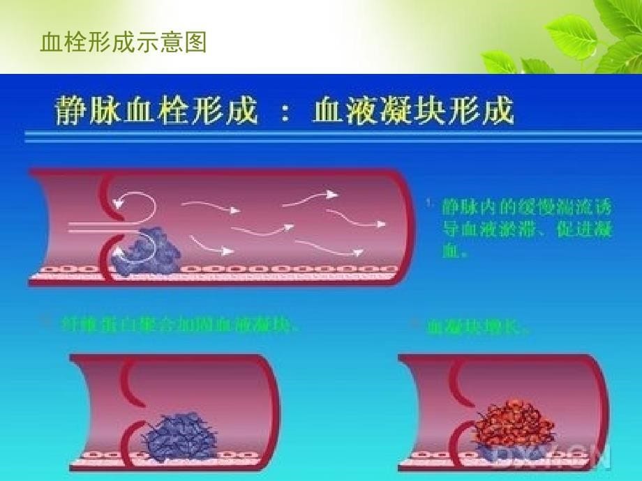 icu患者深静脉血栓形成预防指南_第5页