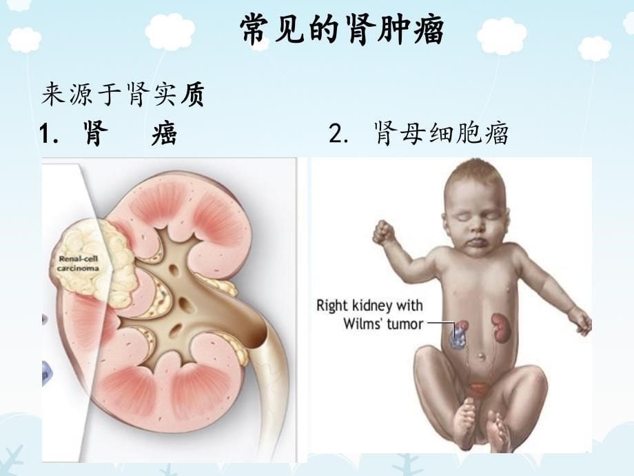 肾肿瘤的围手术期护理ppt课件_第5页