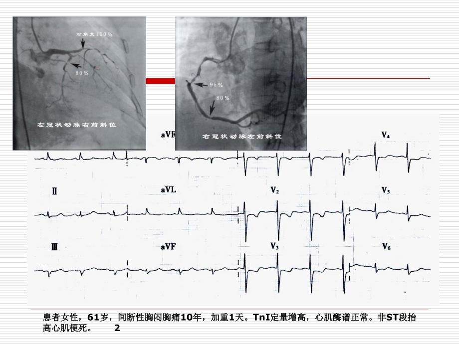 冠状动脉造影与心电图_第2页