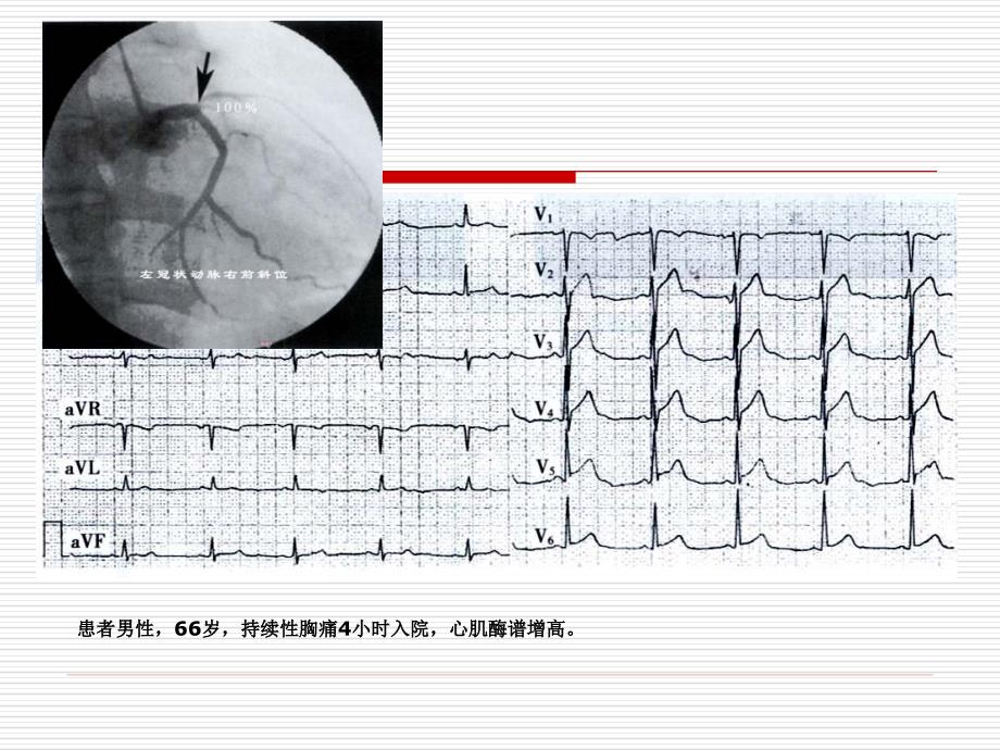 冠状动脉造影与心电图_第3页