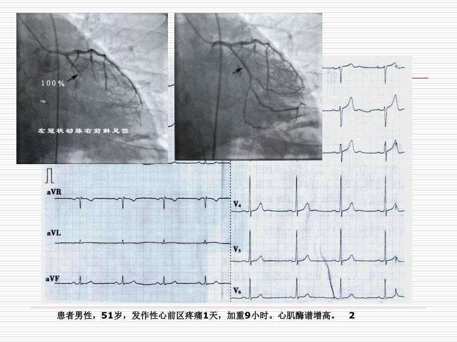 冠状动脉造影与心电图_第4页
