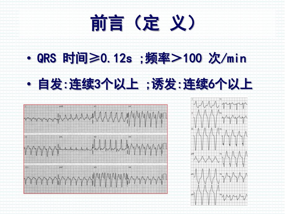 宽qrs心动过速分析思路与鉴别要点医学课件_第3页