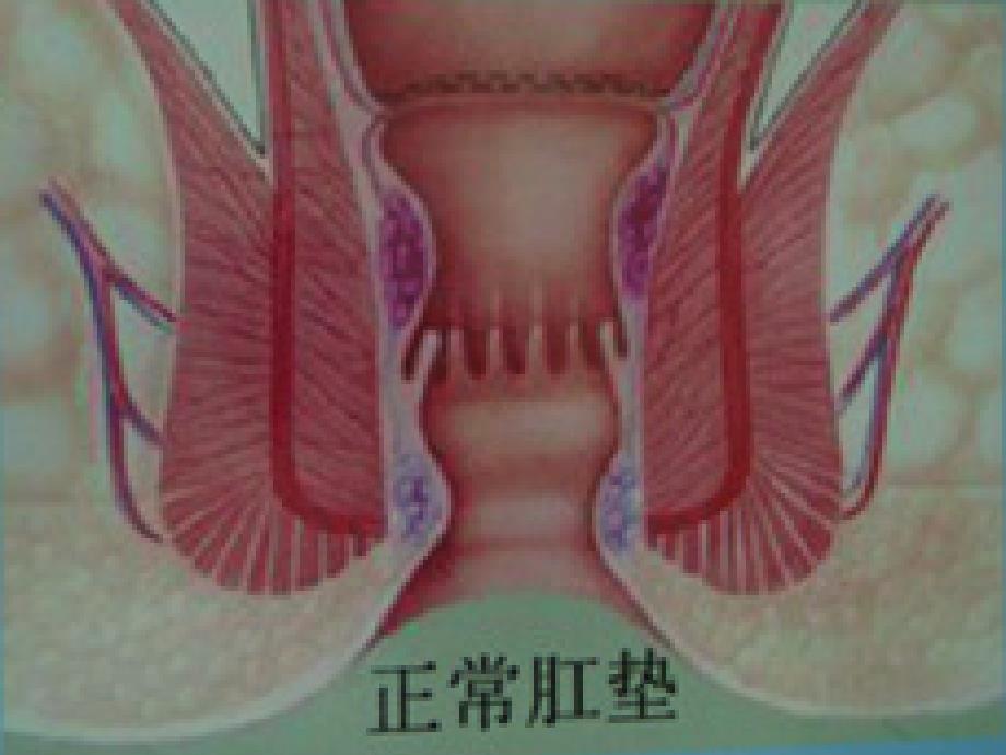 常见肛肠疾病诊疗与预防_第5页