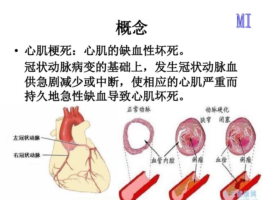 心肌梗死ppt课件_第4页