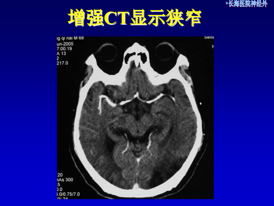 脑供血动脉狭窄的术前评估课件_第4页