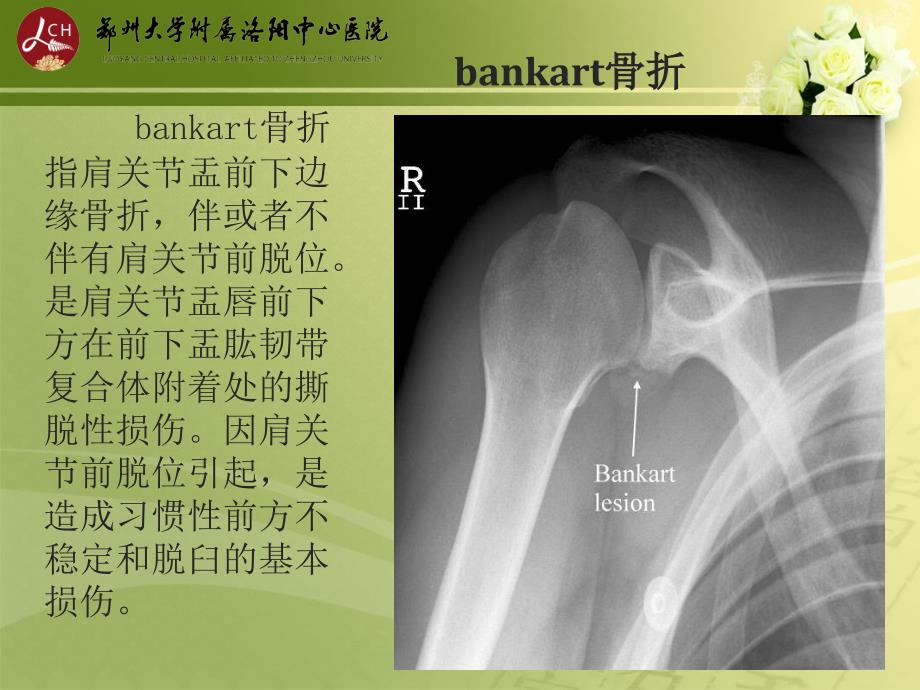 特殊类型骨折课件_第2页