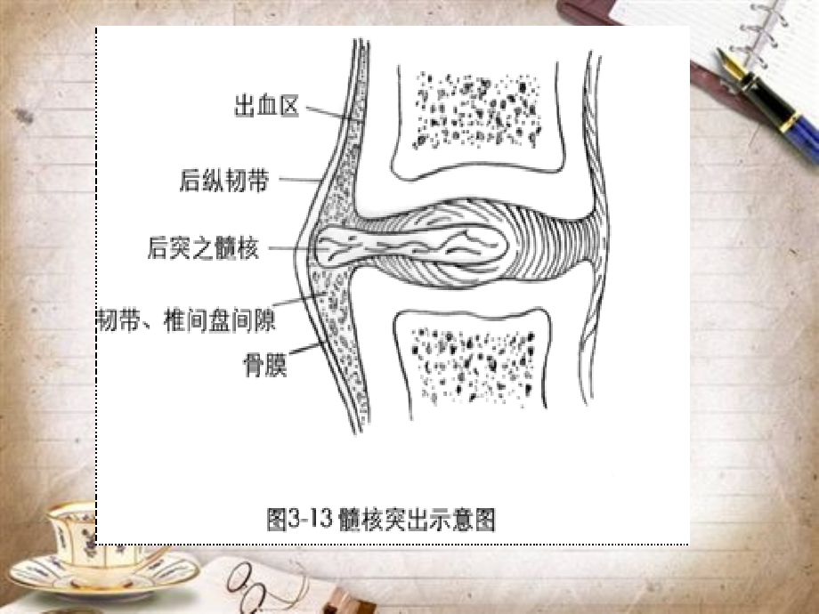 颈椎病知识ppt课件_第3页