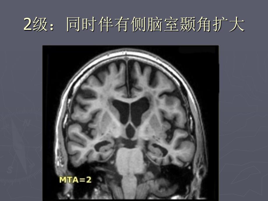 海马萎缩分级mta_第4页