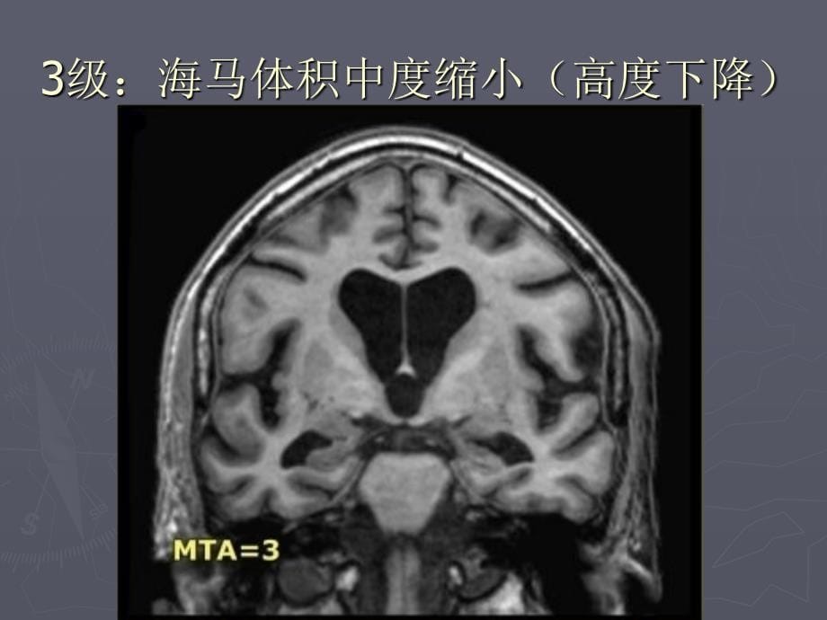 海马萎缩分级mta_第5页