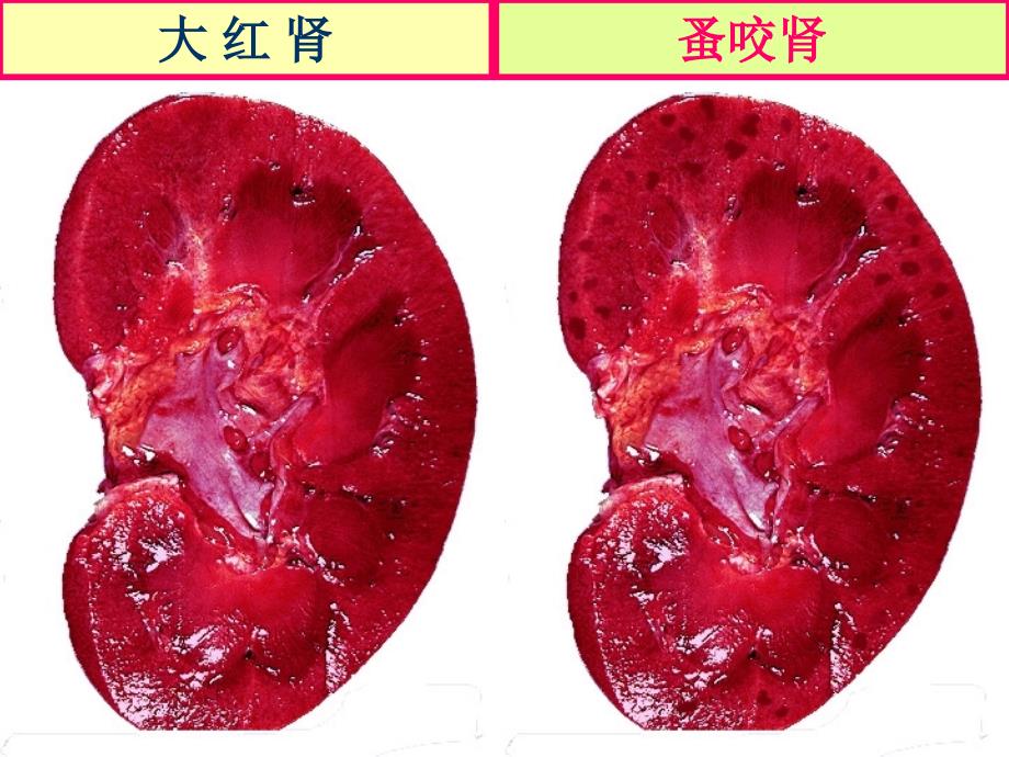 肾小球肾炎（陈东部分）_第4页