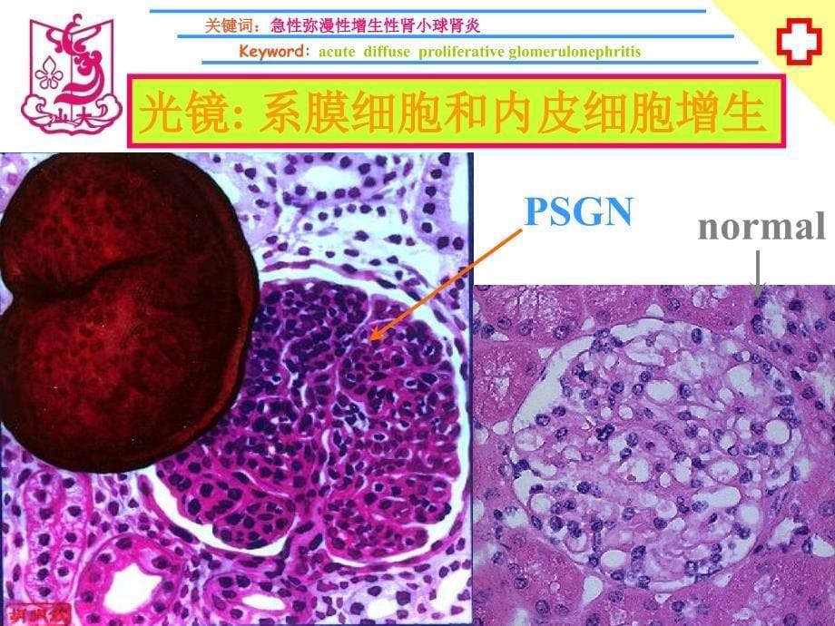 肾小球肾炎（陈东部分）_第5页