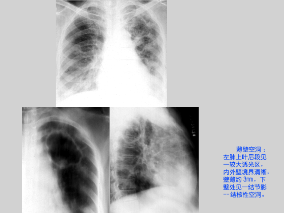 1呼吸影像诊断图X_第3页