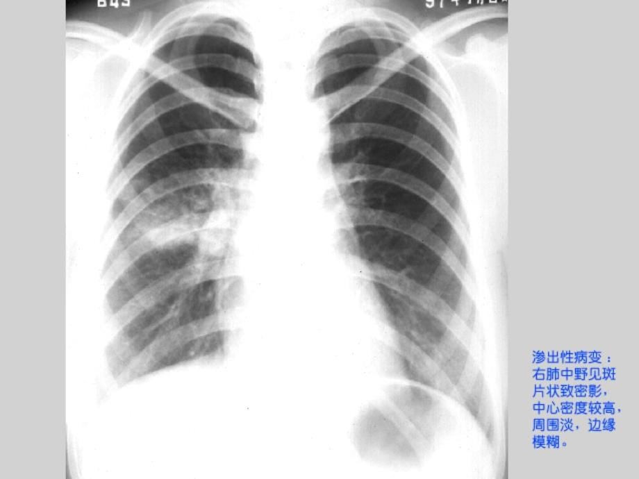 1呼吸影像诊断图X_第5页