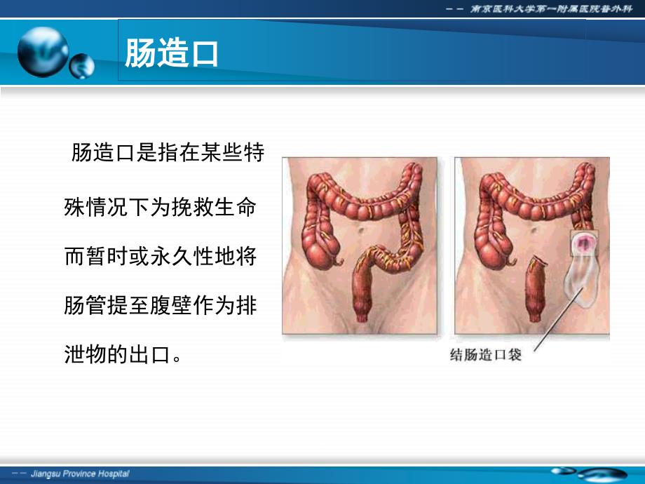 肠造口及其护理(简)_第2页