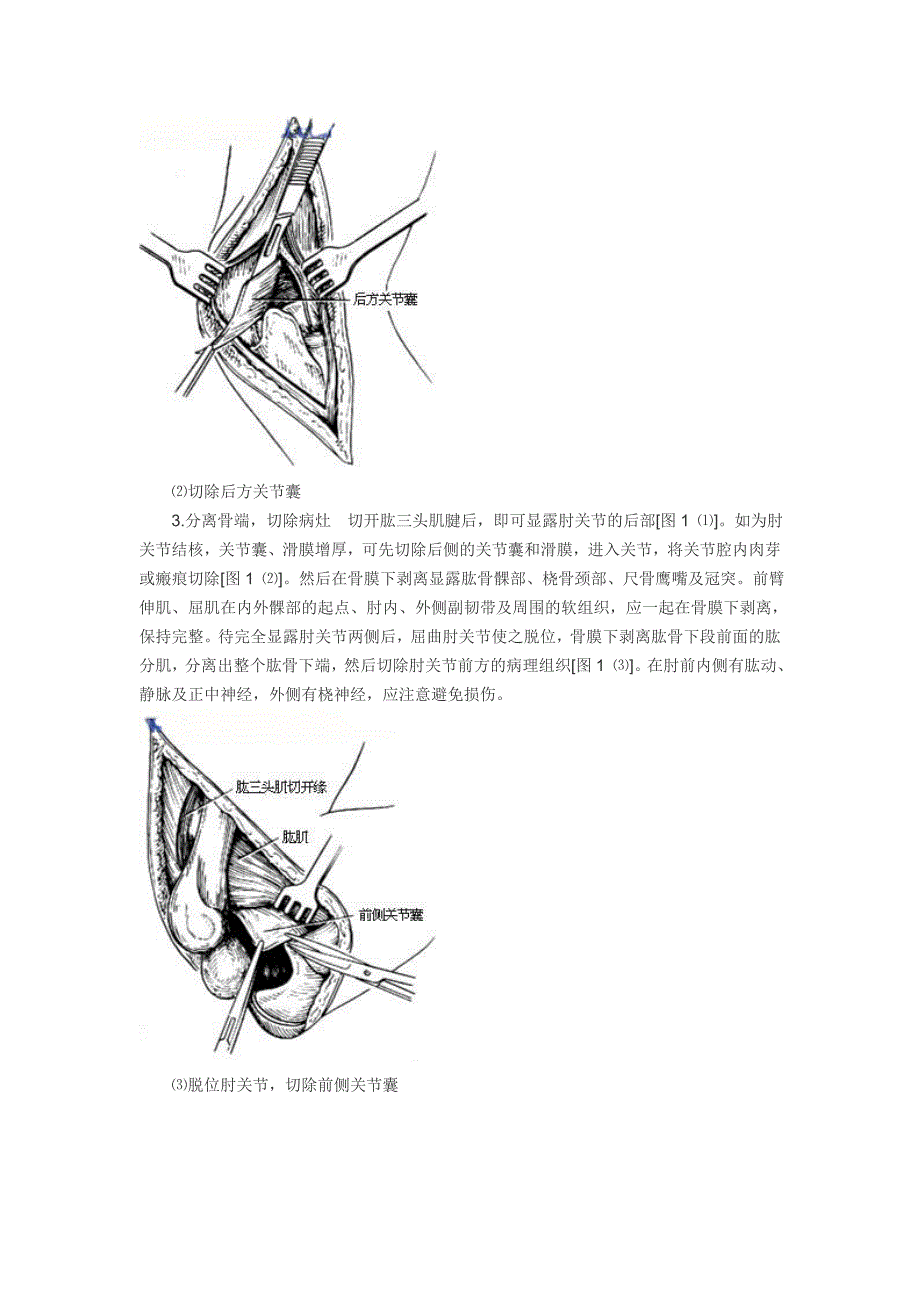 肘关节切除手术_第2页