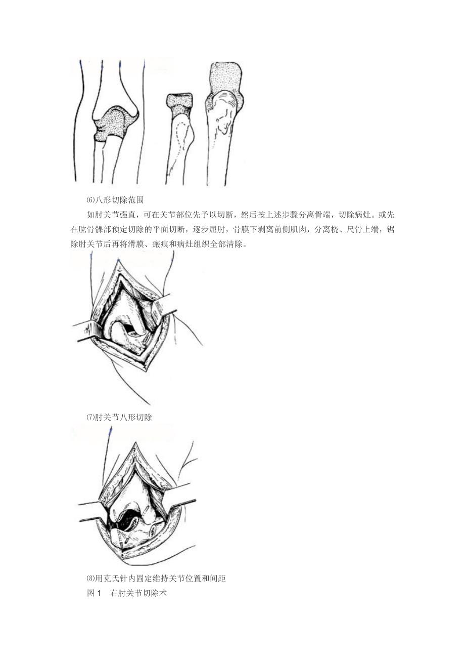 肘关节切除手术_第4页