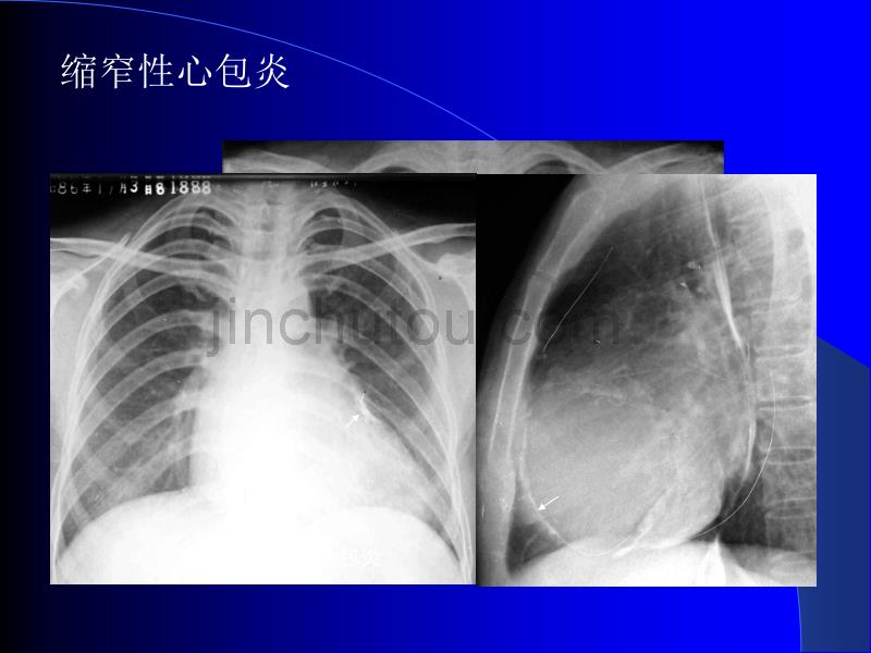 常见病的影像学诊断PPT课件_第4页