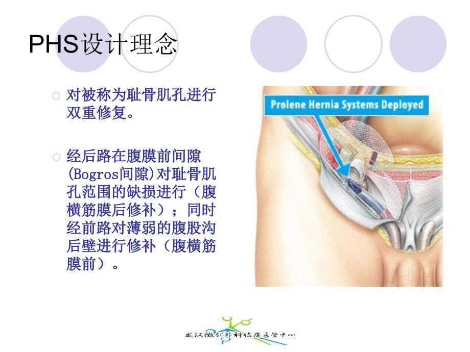 PHS在腹股沟疝修补手术中的应用_第2页