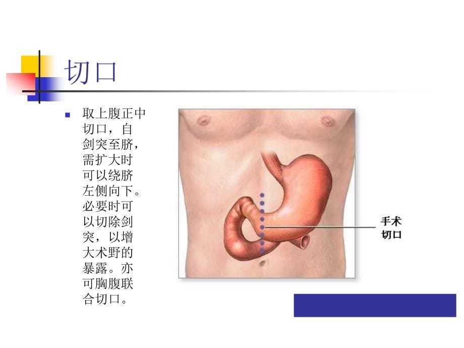 图解全胃切除术(一)_第5页