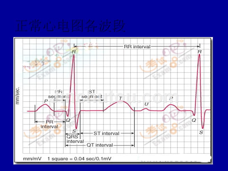 常见病心电图表现PPT课件_第2页