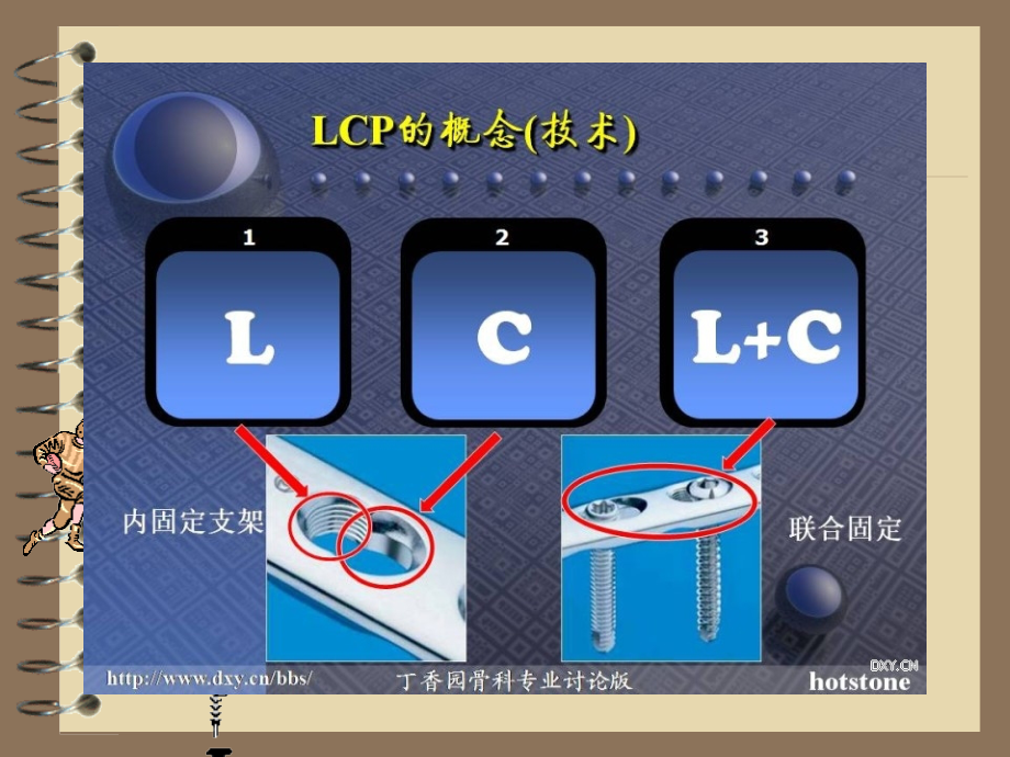 医学资料-骨科-锁定加压钢板技术-【89页全集课件ppt】_第4页