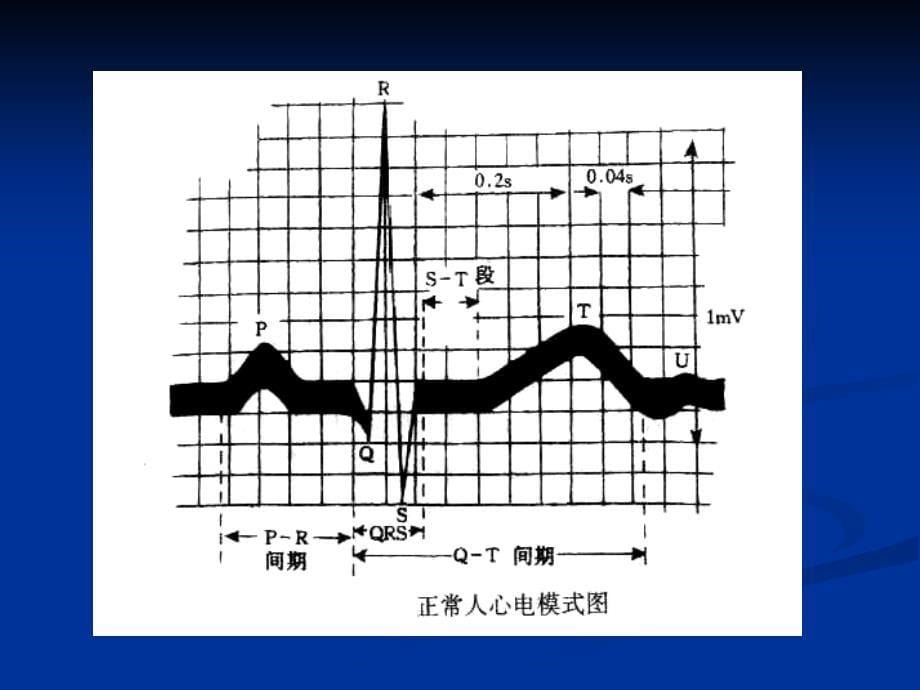 正常心电图及房室肥大（精品PPT）_第5页