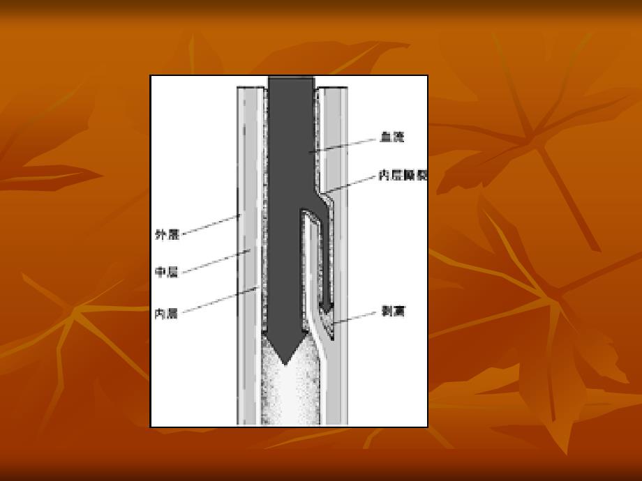 主动脉夹层24840_第3页