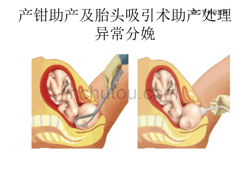 异常分娩-b_第1页