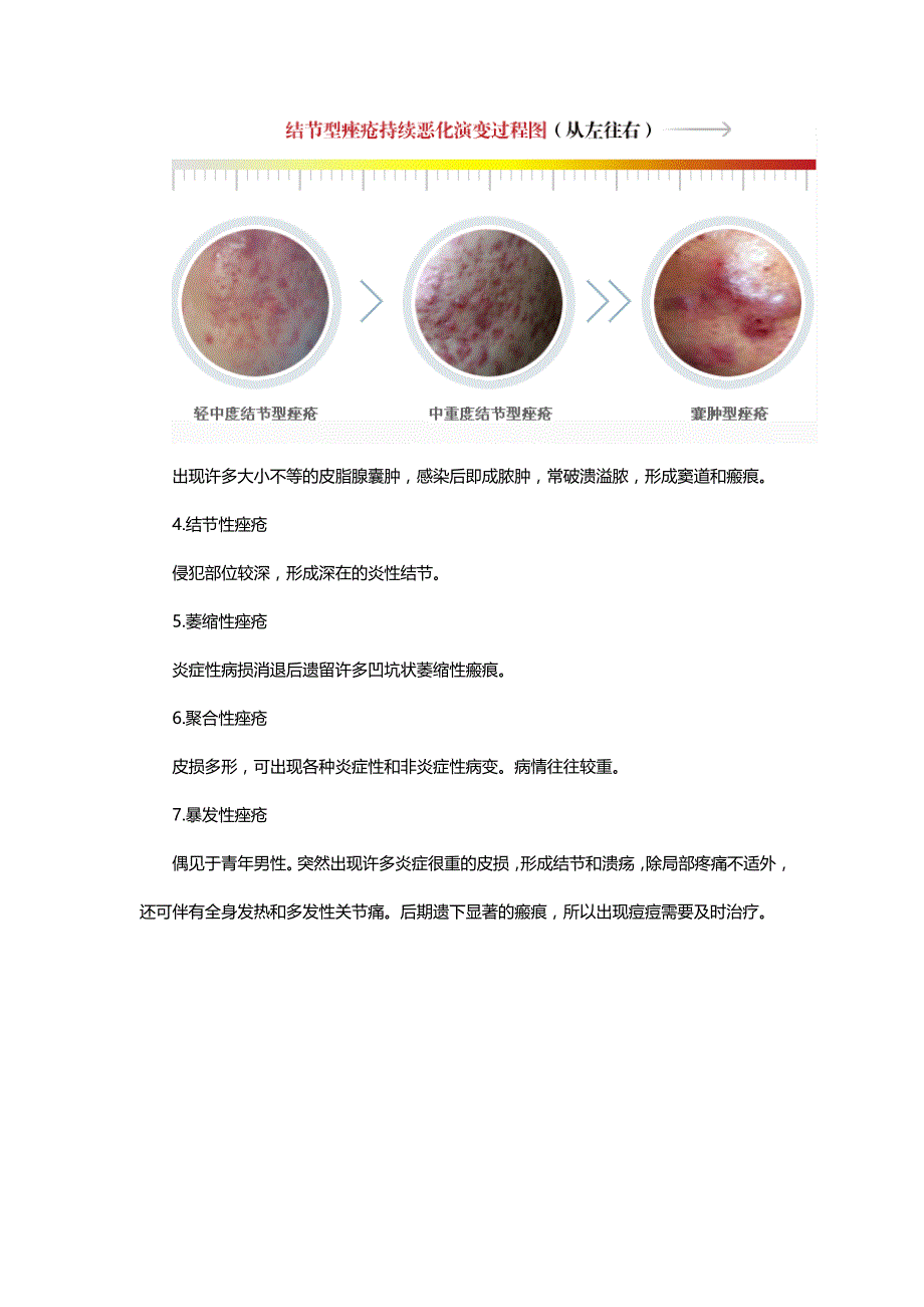 寻常痤疮,了解症状轻松治痤疮_第3页