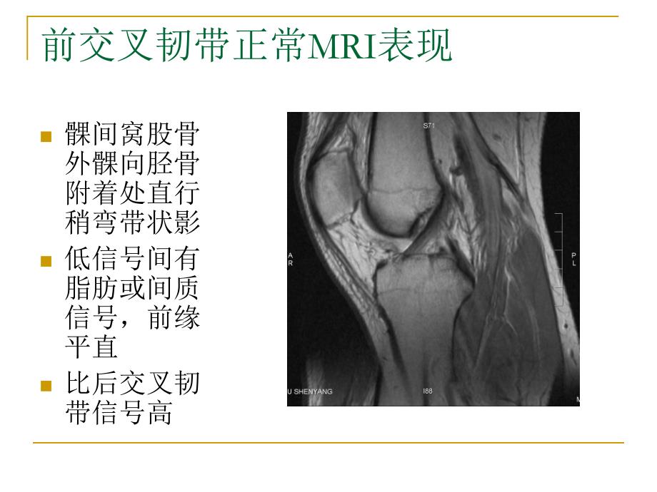 膝关节损伤MRI诊断问题分析_第4页