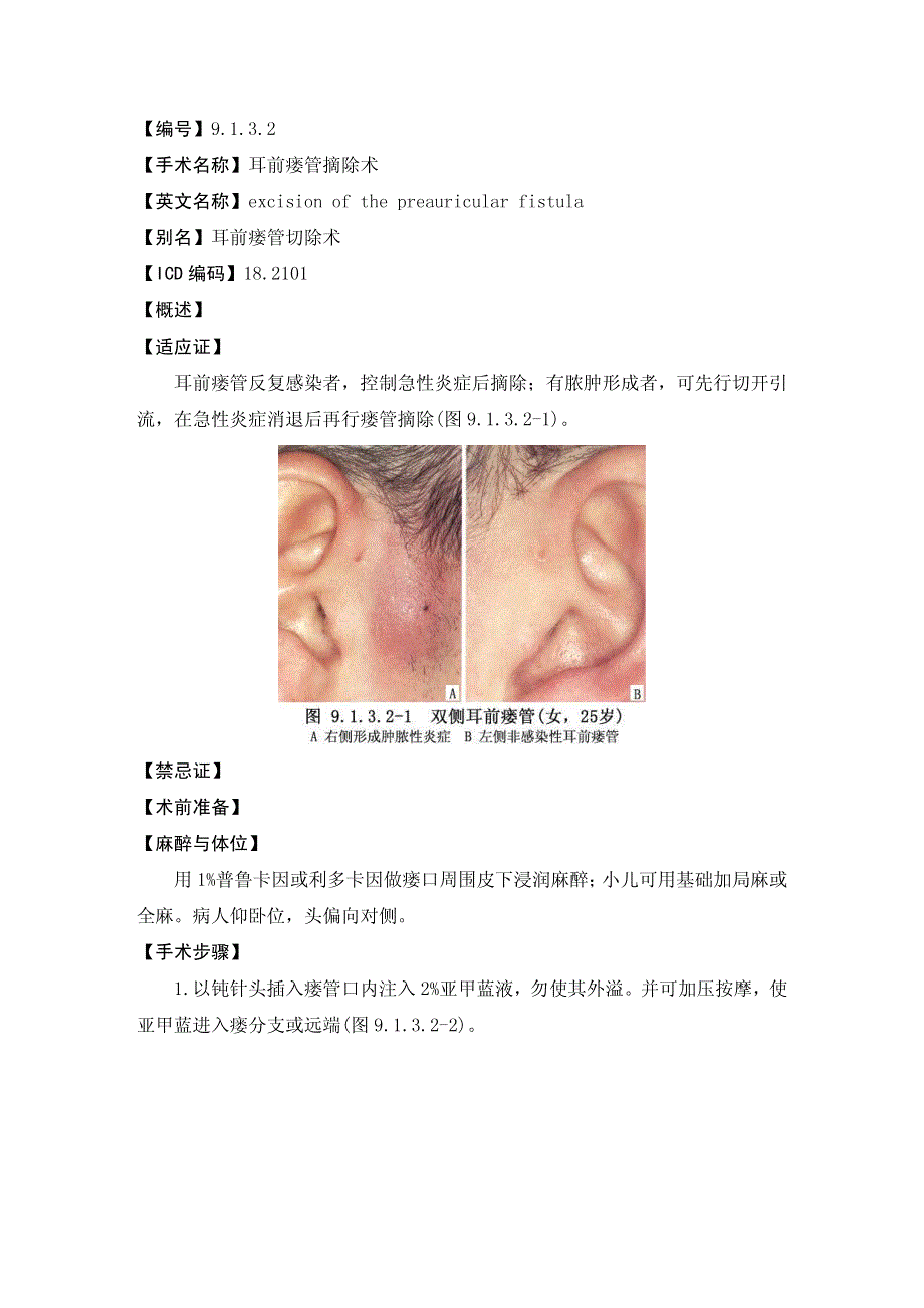 耳前瘘管摘除术[1]_第1页