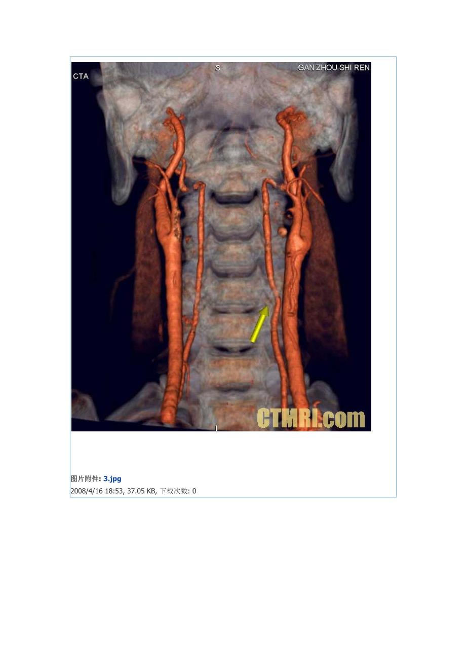 颈椎与椎动脉三维重建_第2页