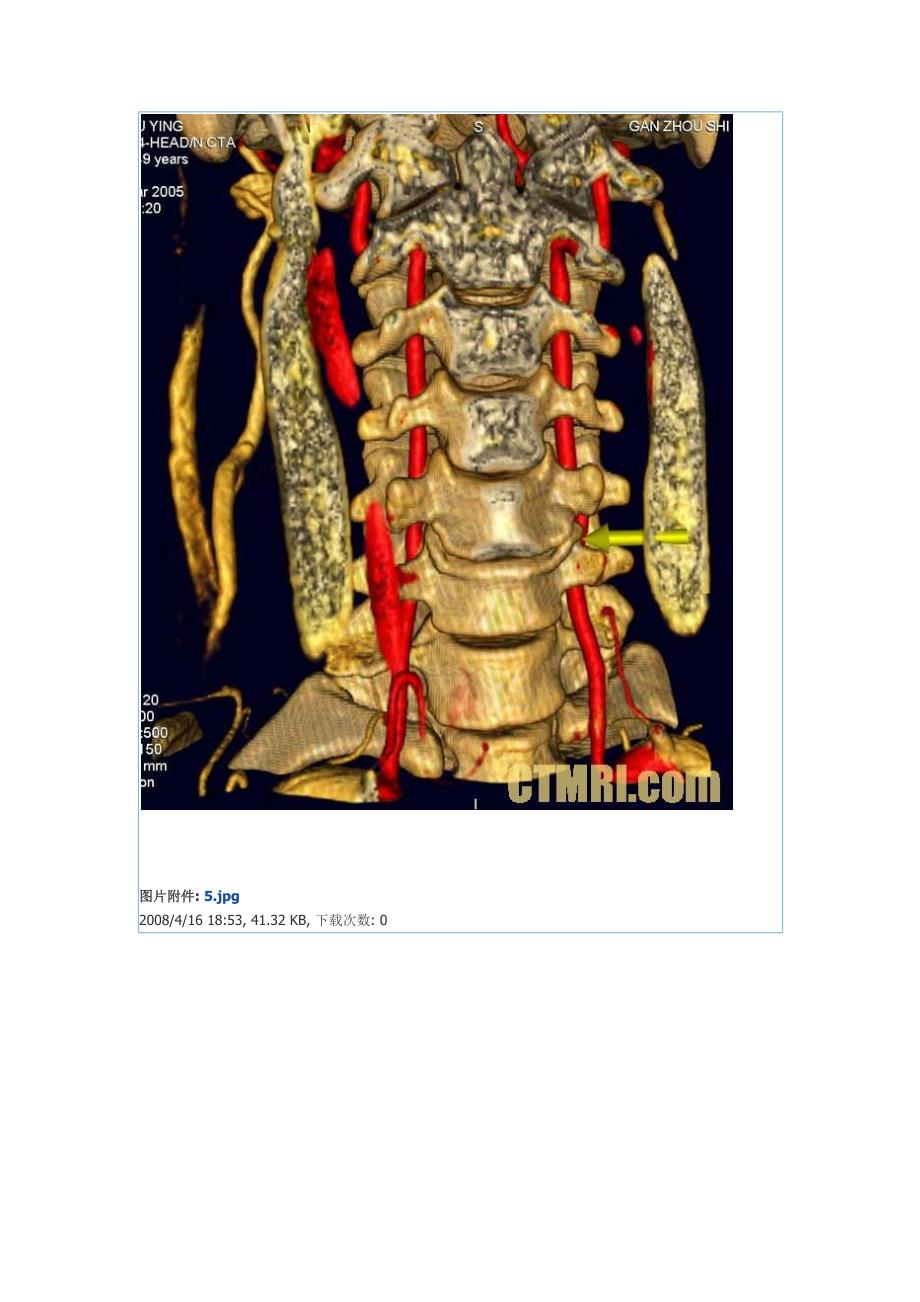 颈椎与椎动脉三维重建_第4页