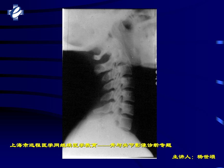 脊柱损伤的影像诊断_第4页