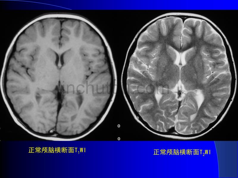 MRI中枢神经系统PPT课件_第5页