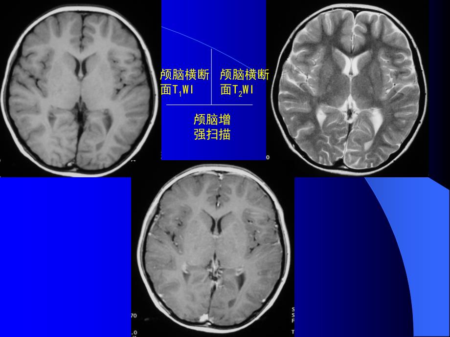 MRI中枢神经系统疾病MRI诊断PPT课件_第3页