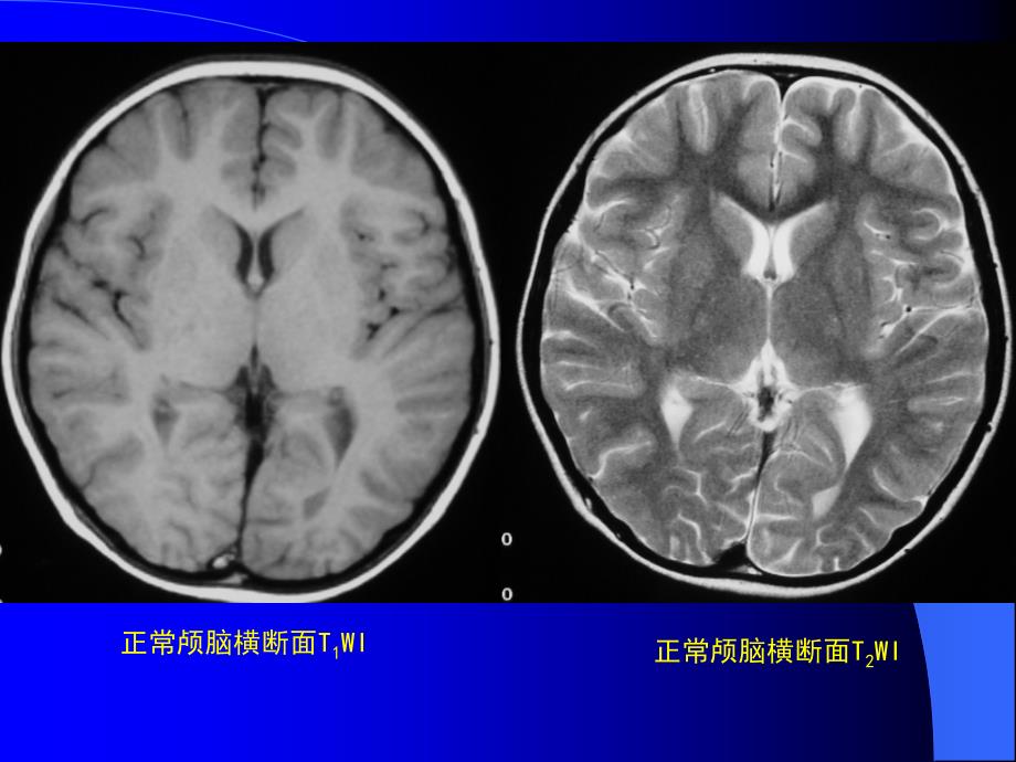 MRI中枢神经系统疾病MRI诊断PPT课件_第5页