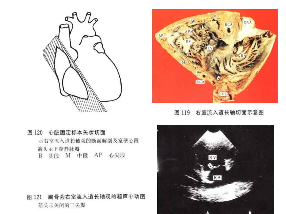 心脏超声与心脏断面解剖及室壁心段_第4页