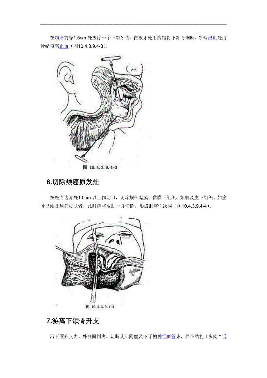 颊癌舌颌颈联合根治_第4页