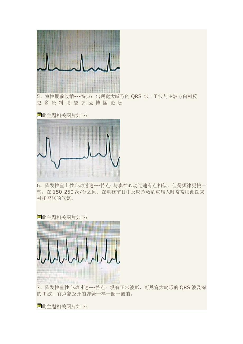 教你快速读懂心电图_第3页