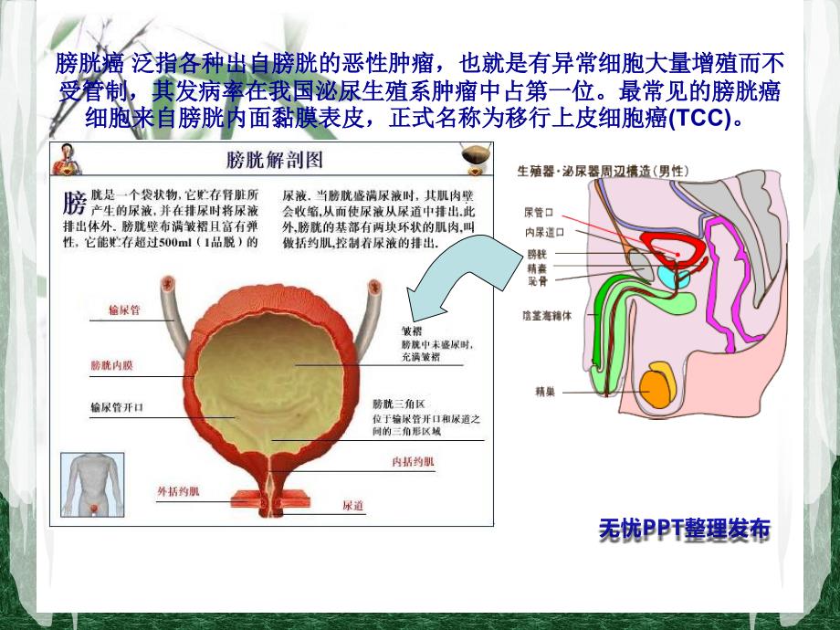 膀胱癌的护理_第1页