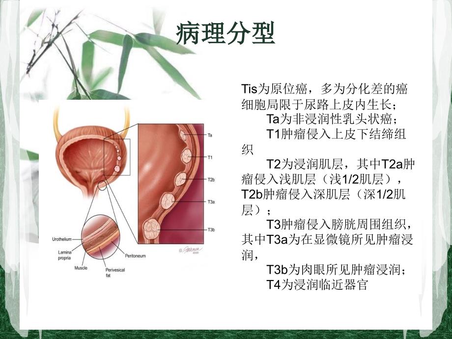 膀胱癌的护理_第3页